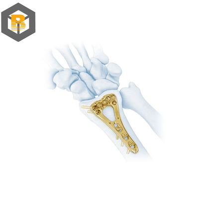 Deeltje voor het bewerken met behulp van CNC-bewerkingen met behulp van een vergrendelingsplaat van de spiraal van de Muti-Axial Distal Radius-plaat-II